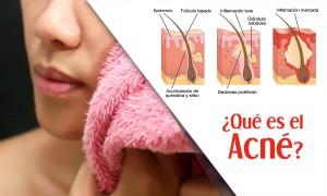 Qué es el acné?