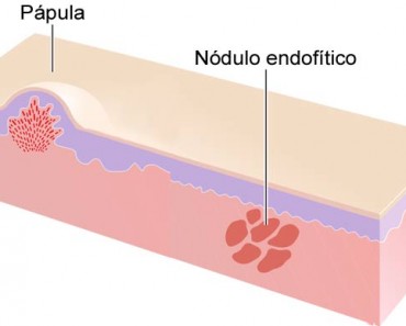 Acné Papuloso: Qué Significa Y Qué Tratamiento Seguir