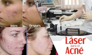 Laser-para-el-acne