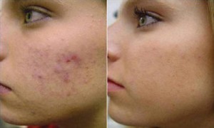 Laser para acne