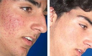 Acne Laser Antes y Despues