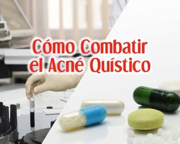 Cómo Combatir El Acné Quístico: Tratamiento