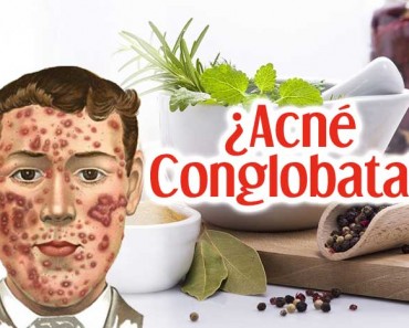 acne conglobata