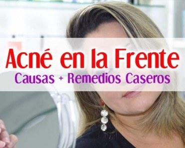 espinillas-acne-frente