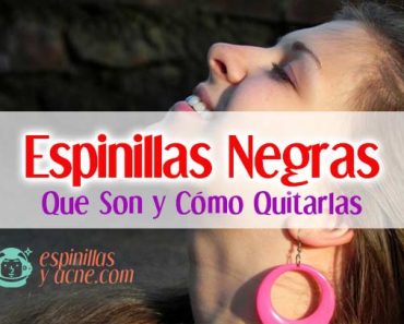 Espinillas negras, qué son y como tratarlas