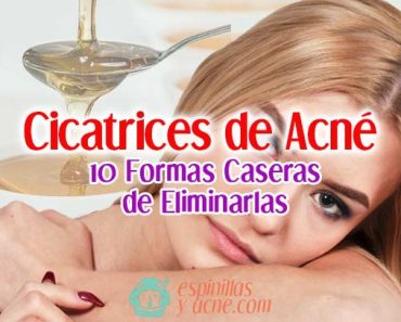 Cicatrices de Espinillas: Eliminar Manchas y Huecos de Forma Casera