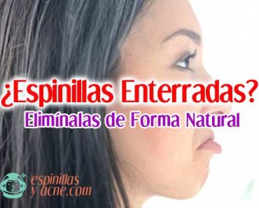 Espinillas Enterradas: Cómo Eliminarlas de Forma Natural