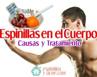 Espinillas en el Cuerpo: Causas y Soluciones