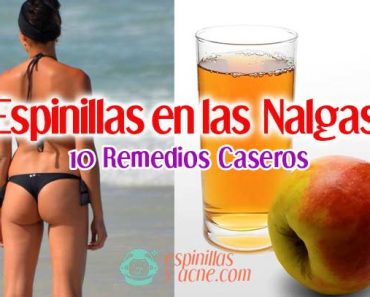 Espinillas en las Nalgas