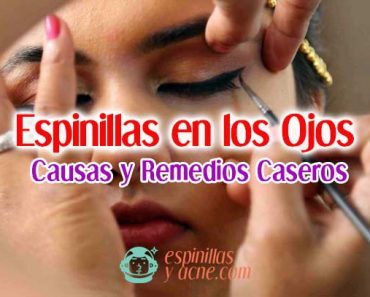 Espinillas en los Ojos y los Párpados