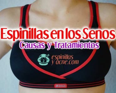 Espinillas en los Senos