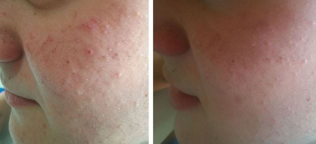 Cicatrices de acné antes y después