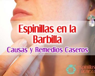 Espinillas En La Barbilla: Causas y Remedios Caseros