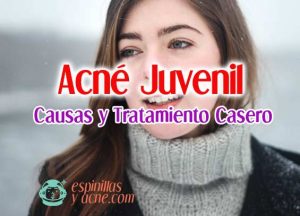 acne juvenil
